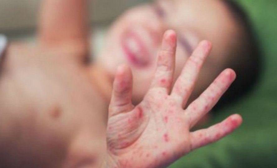 अमेरिकामा दादुराको प्रकोप तीव्र, सङ्क्रमितको सङ्ख्या तीन हजार पार